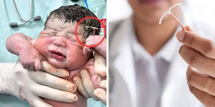 bébé avec un stérilet