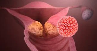 Virus du Papillome Humain HPV
